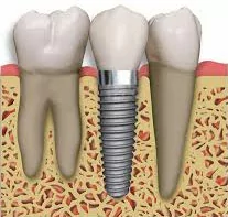tooth implant dentistry