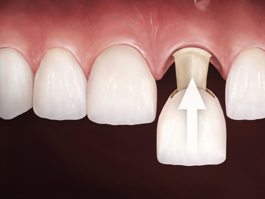 Dentist In Alvin TX Porcelain Crowns