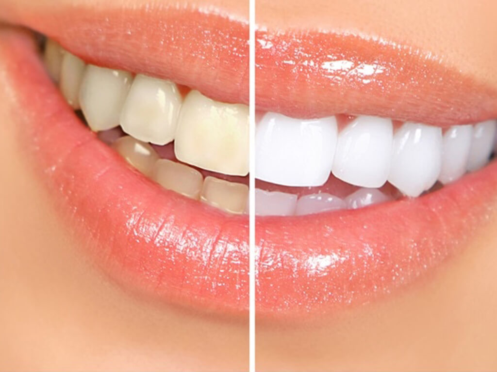 Dentist In Alvin TX Teeth Whitening