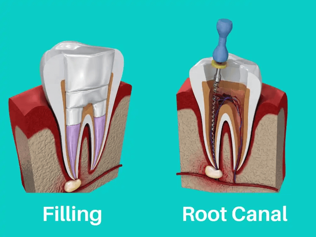 Dentist in Alvin TX Root Canal