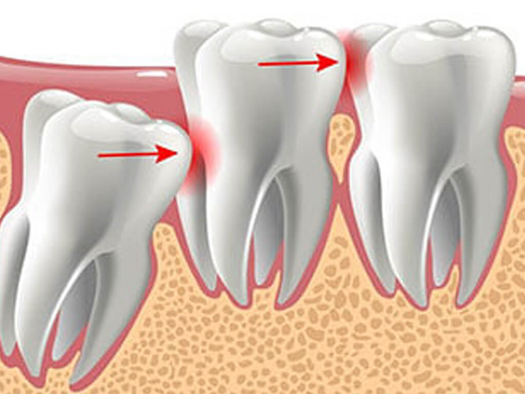 Dentist in Alvin TX Wisdom Teeth