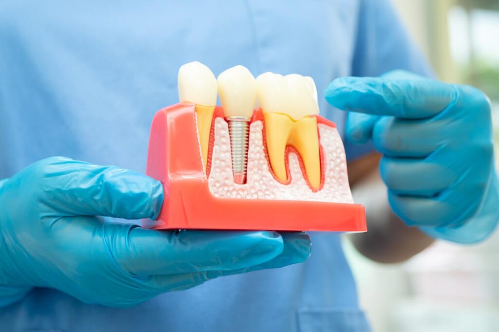 dental implants in Alvin TX