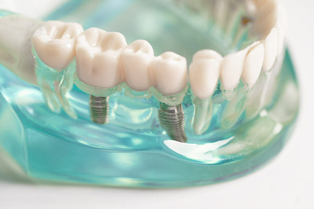 dental implants reflection cosmetic dentistry alvin tx