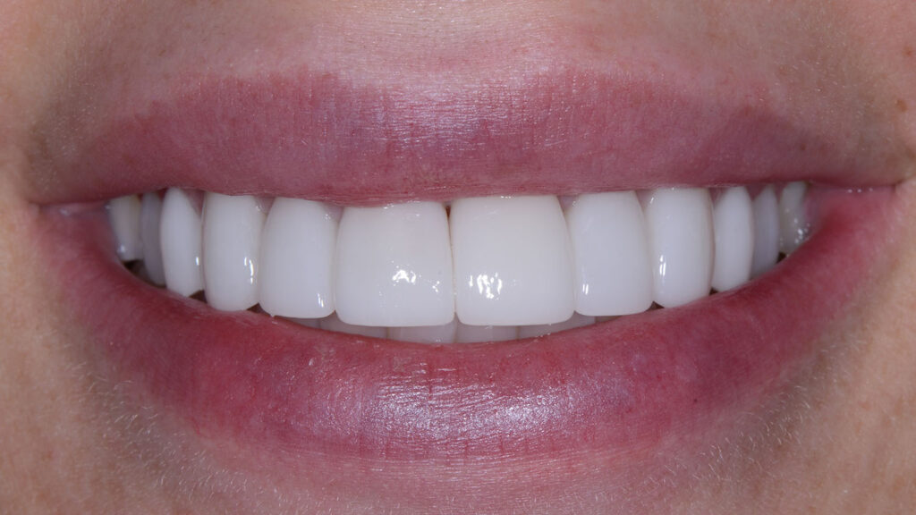 Porcelain Veneers