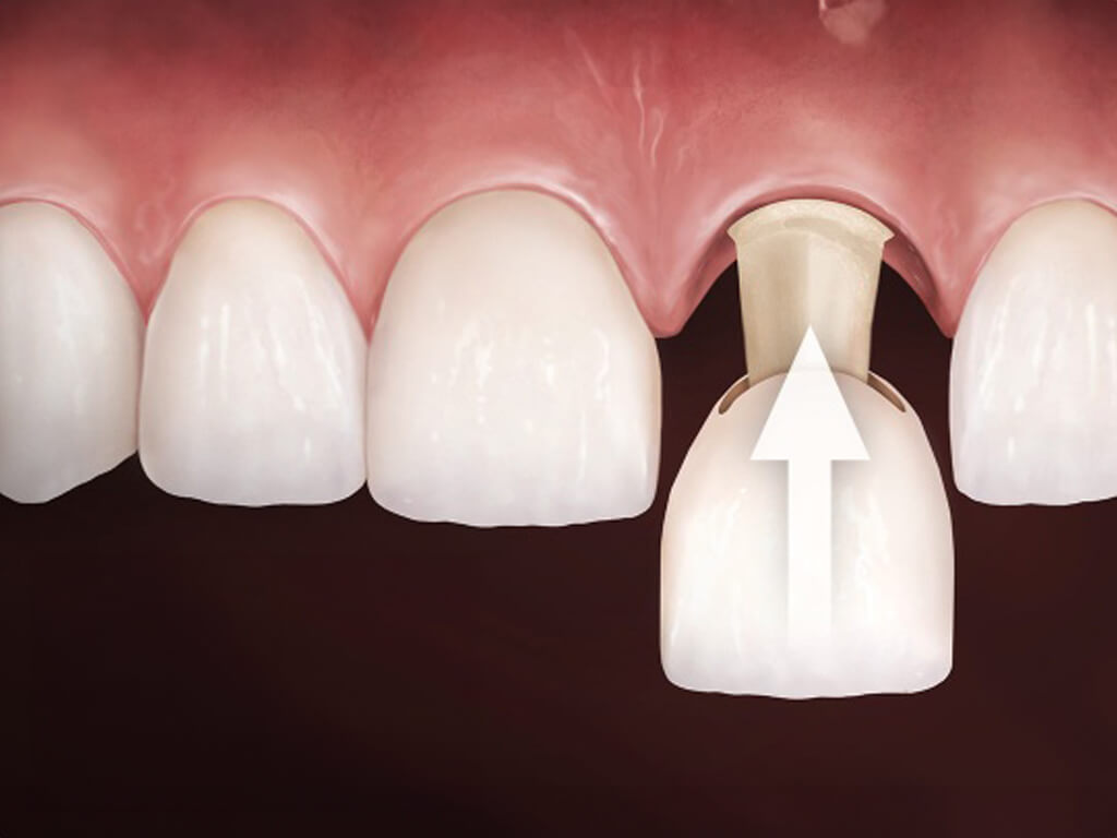 porcelain crowns