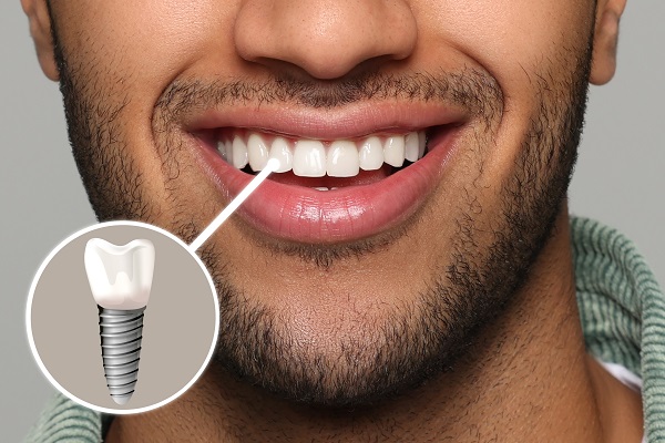 dental implants