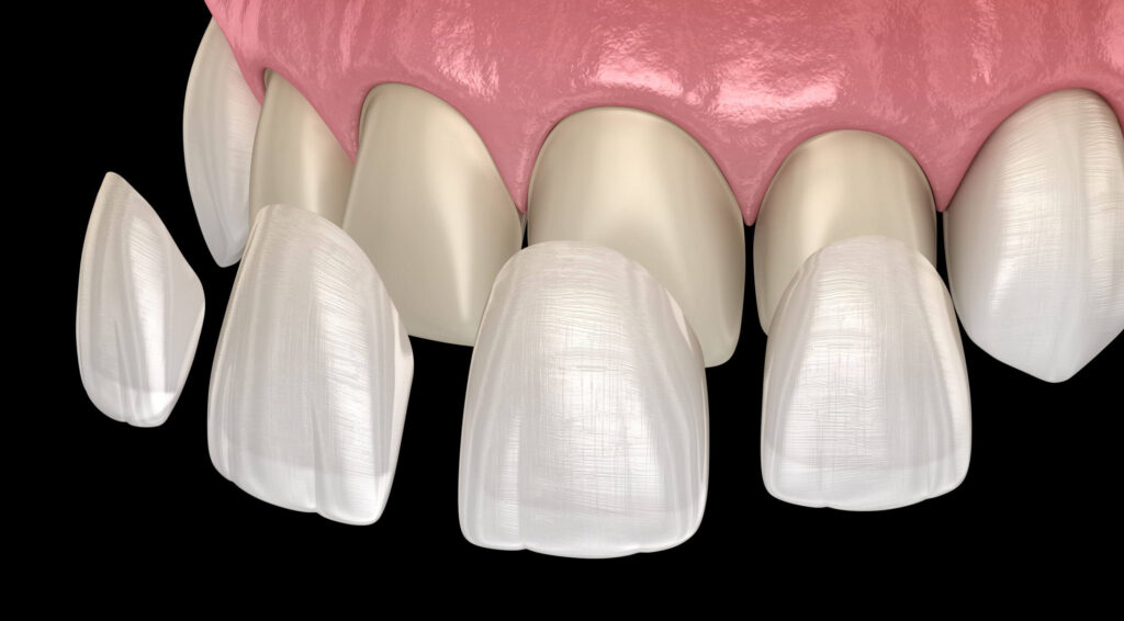 porcelain veneers