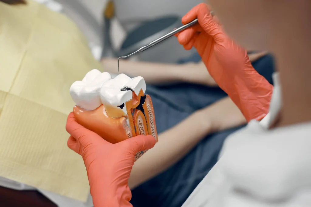 root canal